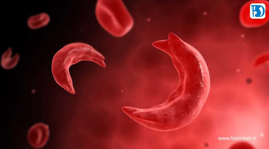 World Sickle Cell Day - June 19 - FastRead.in